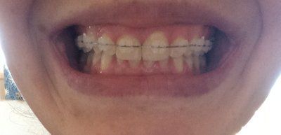 Hành trình niềng răng ở tuổi 22