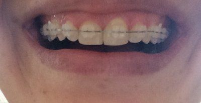 Hành trình niềng răng ở tuổi 22