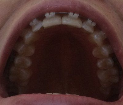 Hành trình niềng răng ở tuổi 22