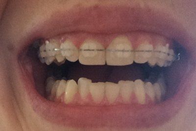 Hành trình niềng răng ở tuổi 22