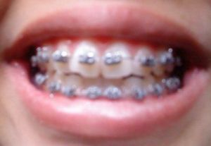 Niềng răng trong bao lâu để răng thẳng lại?