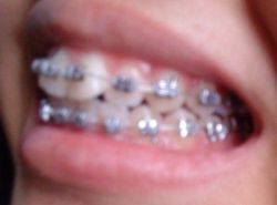 Niềng răng trong bao lâu để răng thẳng lại?