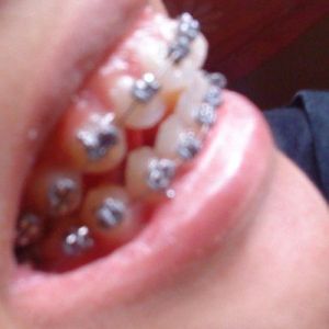 Niềng răng trong bao lâu để răng thẳng lại?