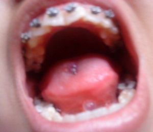 Niềng răng trong bao lâu để răng thẳng lại?