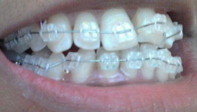 Trải nghiệm về quá trình niềng răng