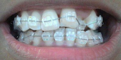 Trải nghiệm về quá trình niềng răng