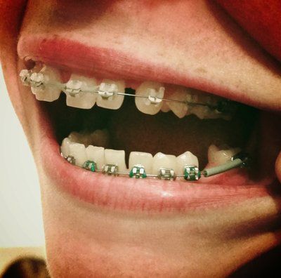 Niềng răng để khắc phục răng thưa