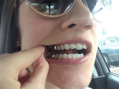 Niềng răng ở tuổi 28