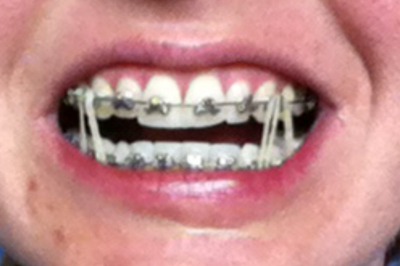 Niềng răng kim loại hiệu quả nhanh hơn và tốt hơn