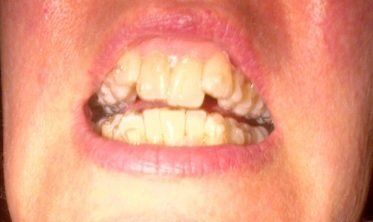 Nhật ký niềng răng trong suốt invisalign