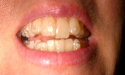 Nhật ký niềng răng trong suốt invisalign