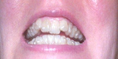 Nhật ký niềng răng trong suốt invisalign