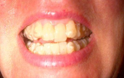 Nhật ký niềng răng trong suốt invisalign