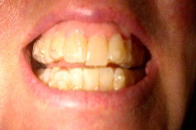 Nhật ký niềng răng trong suốt invisalign