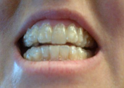 Nhật ký niềng răng trong suốt invisalign