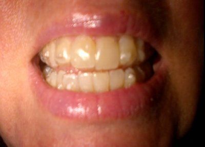 Nhật ký niềng răng trong suốt invisalign