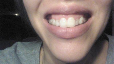 Trải nghiệm niềng răng Invisalign lần đầu