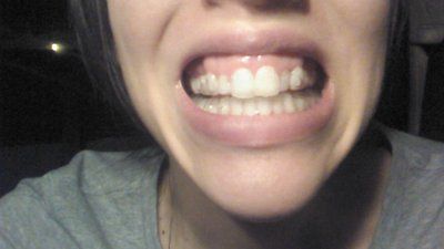 Trải nghiệm niềng răng Invisalign lần đầu