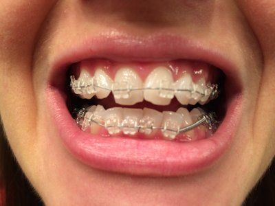 Niềng răng ở tuổi 28