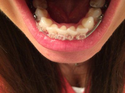 Niềng răng ở tuổi 28