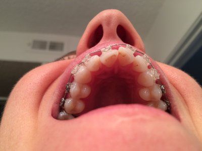 Niềng răng ở tuổi 28