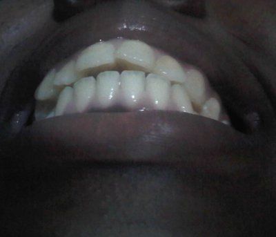 Có thể khắc phục được tình trạng răng chen chúc xô lệch mà không cần nhổ răng không?