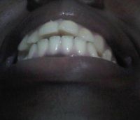 Có thể khắc phục được tình trạng răng chen chúc xô lệch mà không cần nhổ răng không?