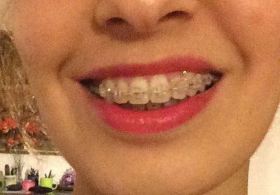 27 tuổi- niềng răng mắc cài trong suốt để khắc phục hô vẩu