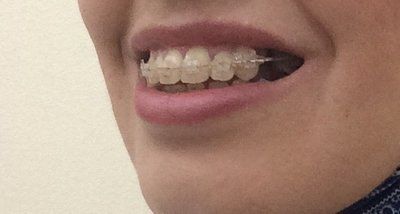27 tuổi- niềng răng mắc cài trong suốt để khắc phục hô vẩu