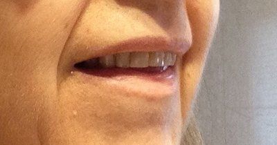 Niềng răng Invisalign ở tuổi 57