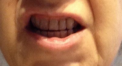 Niềng răng Invisalign ở tuổi 57