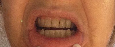 Niềng răng Invisalign ở tuổi 57