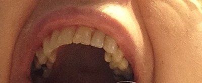 Niềng răng Invisalign ở tuổi 57