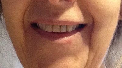 Niềng răng Invisalign ở tuổi 57