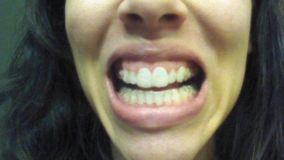 Trải nghiệm niềng răng Invisalign lần đầu