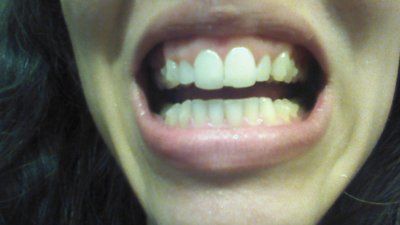 Trải nghiệm niềng răng Invisalign lần đầu