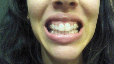 Trải nghiệm niềng răng Invisalign lần đầu