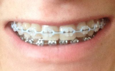 Niềng răng truyền thống để chữa răng khấp khểnh và một số tip