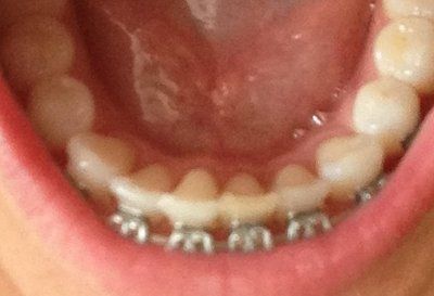 Niềng răng truyền thống để chữa răng khấp khểnh và một số tip