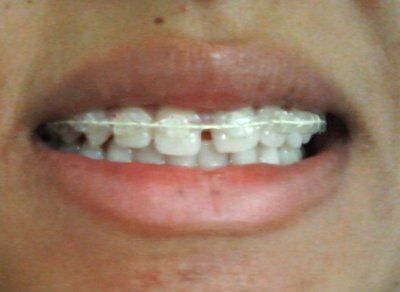 Kết quả niềng răng six month smile mang lại cho mình