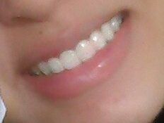 Kết quả niềng răng six month smile mang lại cho mình