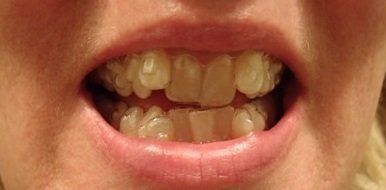 Nhật ký niềng răng trong suốt invisalign