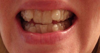 Nhật ký niềng răng trong suốt invisalign