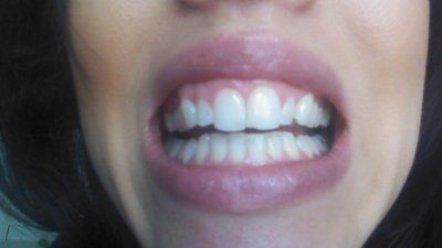Trải nghiệm niềng răng Invisalign lần đầu
