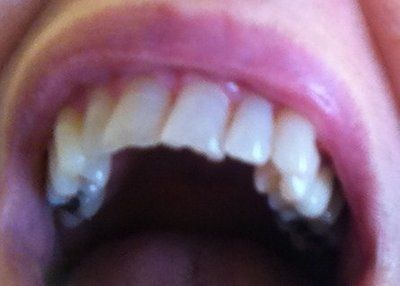 Niềng răng Invisalign ở tuổi 57