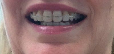 Niềng răng ở tuổi 50