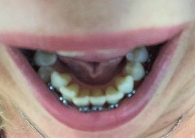 Niềng răng ở tuổi 50