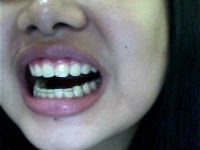 Hàm duy trì có thể dịch chuyển lại răng sau khi tháo niềng răng 6 tháng không?