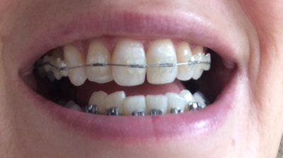 Niềng răng ở tuổi 50