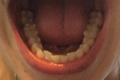 Hành trình niềng răng ở tuổi 22